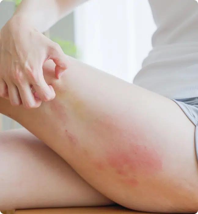 Eczema Treatment Online in Ireland, What is Eczema