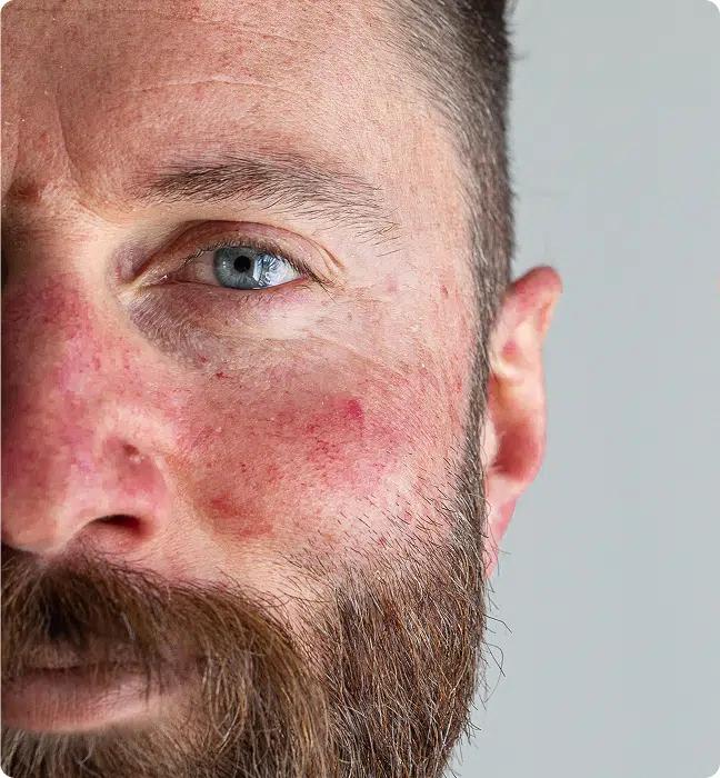 Rosacea Treatment in Ireland, What is Rosacea