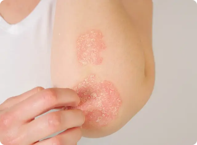 Eczema treatment online Ireland