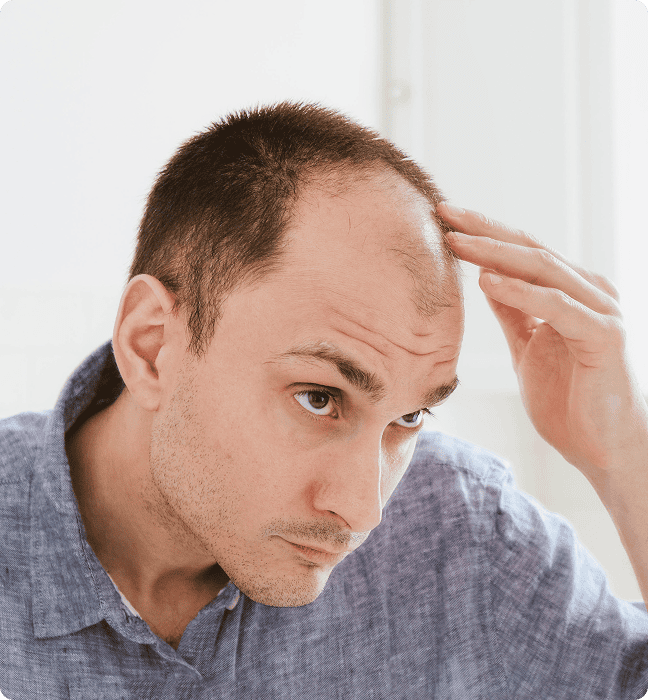 What is Male Pattern Hair Loss?