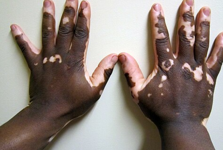 Vitilinox concept showing skin pigmentation support and even skin tone improvement illustration