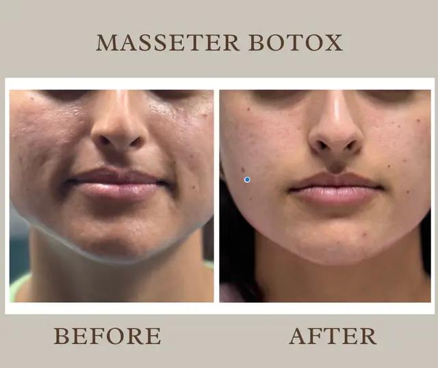 Botox Before and After