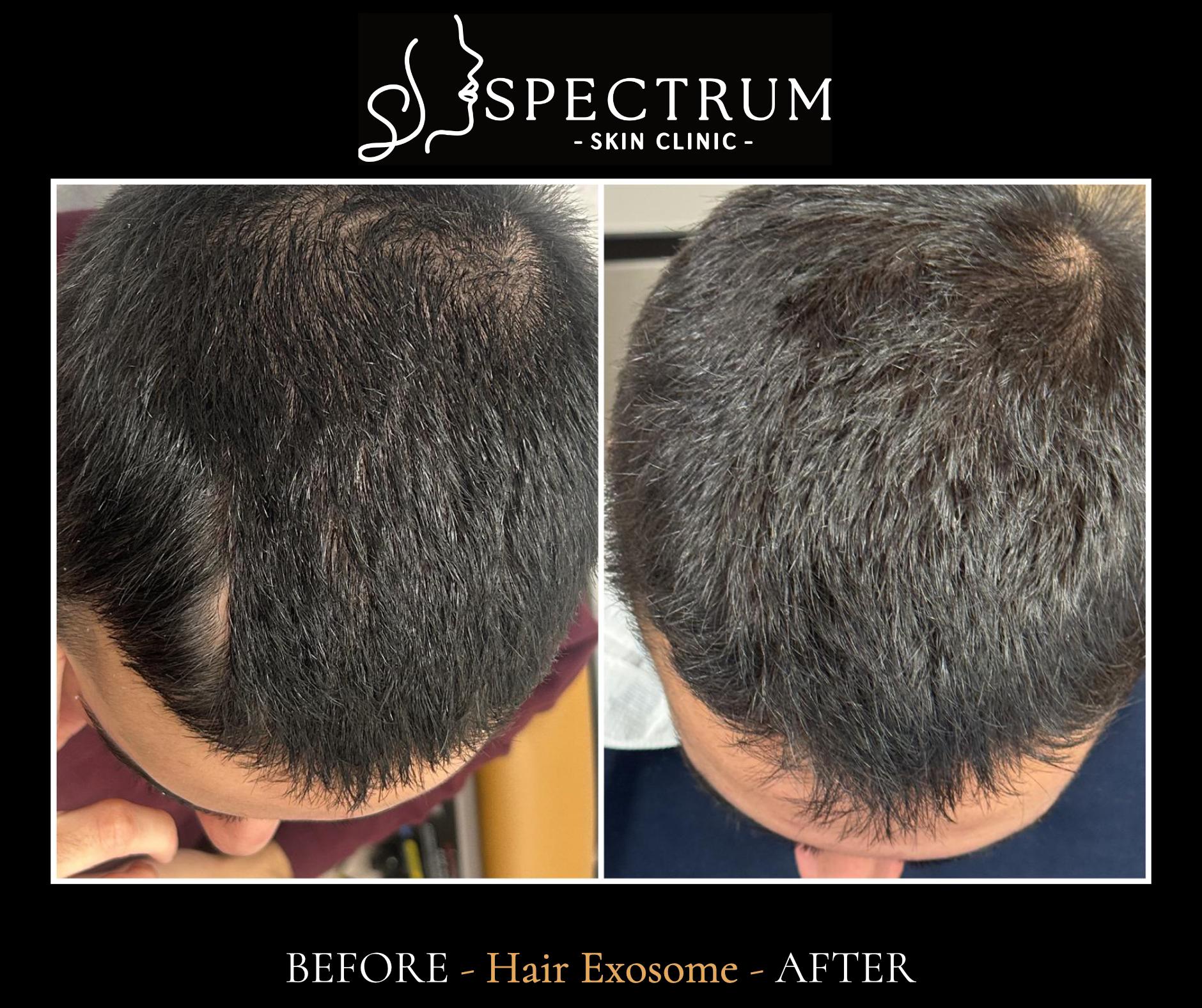 Hair Restoration in Irvine, CA — Exosome Therapy & Selphyl PRFM | The Pur Health in Orange County, Irvine, CA