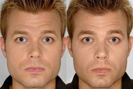 Cheekbone Enhancement for Asymmetrical Cheeks