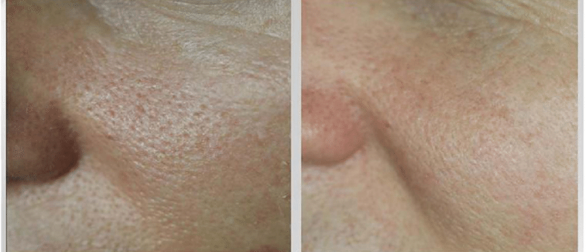 Reduction of Pore Size