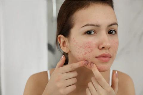 Acne and Acne Scars