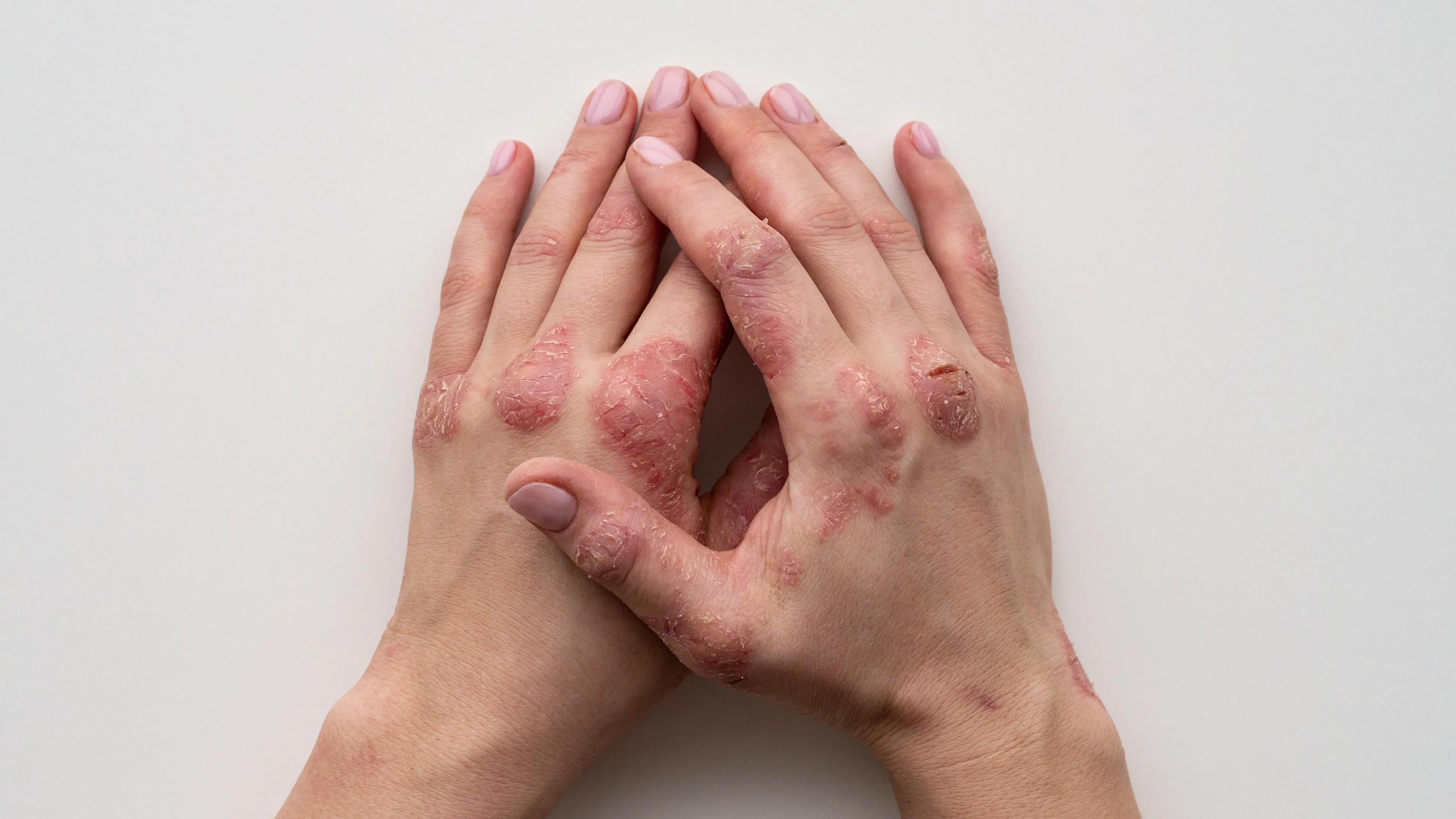 Calming of Eczema and Psoriasis