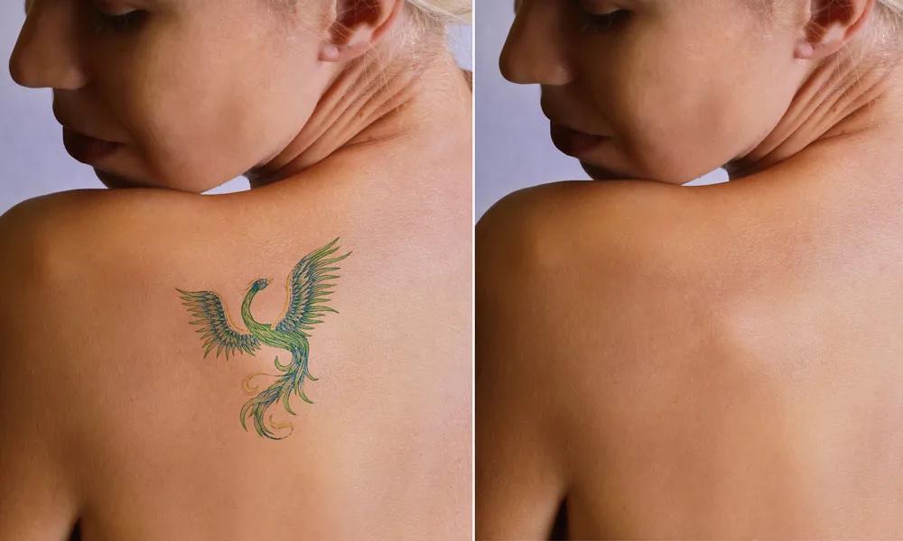 Tattoo Removal - Achieve a clean slate