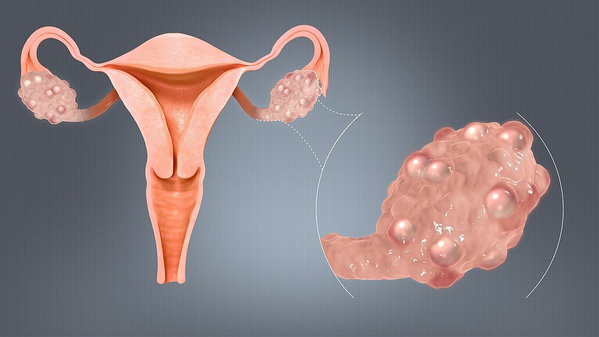 PCOS (Polycystic Ovary Syndrome)