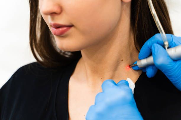 Wart | Skin Tag Removal