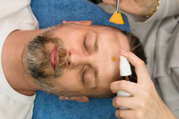 What is the TCA Peel?