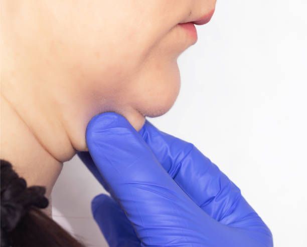 Kybella - Reduce Submental Fat