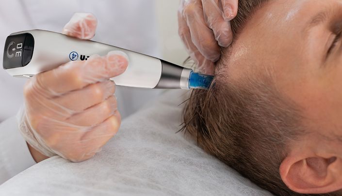 Exosome Therapy for Hair Thinning and Hair Loss