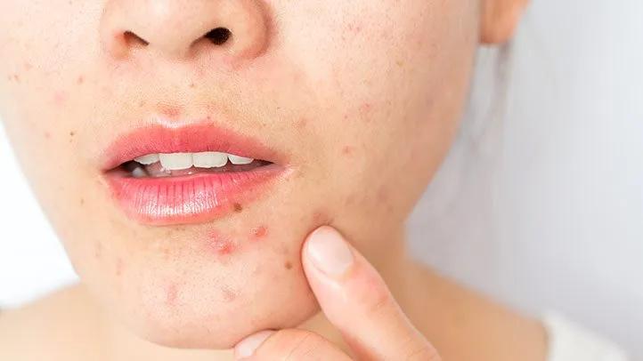 Acne and Blemishes 