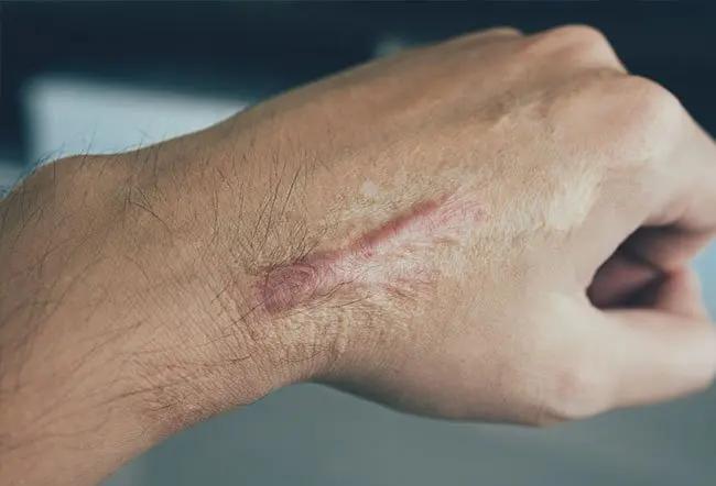 Scar Remodeling Techniques