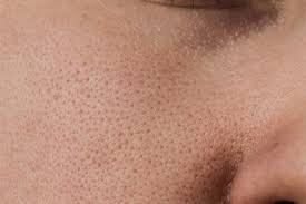 Acne and Acne Scars