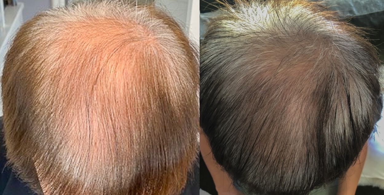 Exosome Therapy for Androgenic Alopecia
