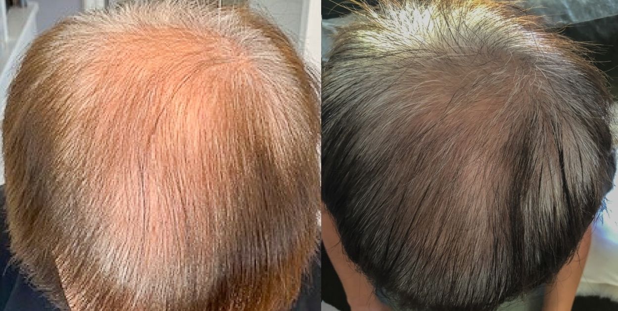 Exosome for Hair Loss