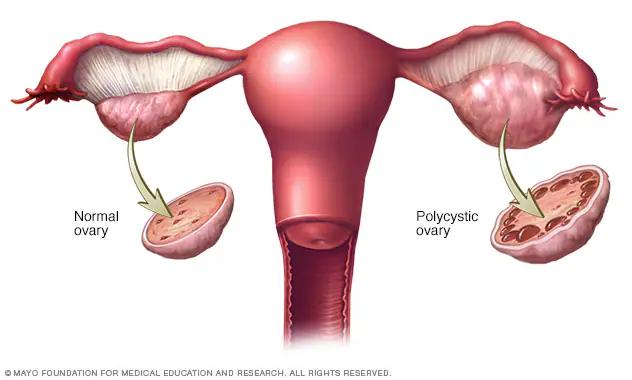 PCOS (Polycystic Ovary Syndrome)