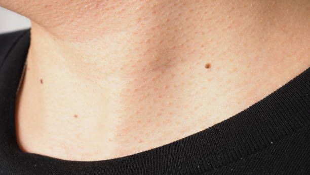 Post-Procedure Care and Recovery