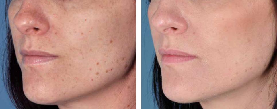 Zo Peel - Transform Your Skin