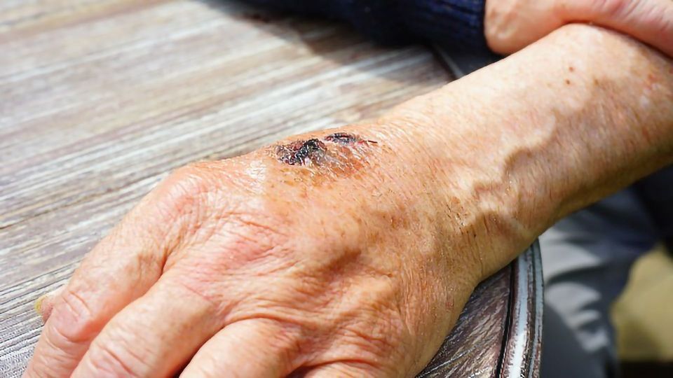 Exosome for Wound Healing