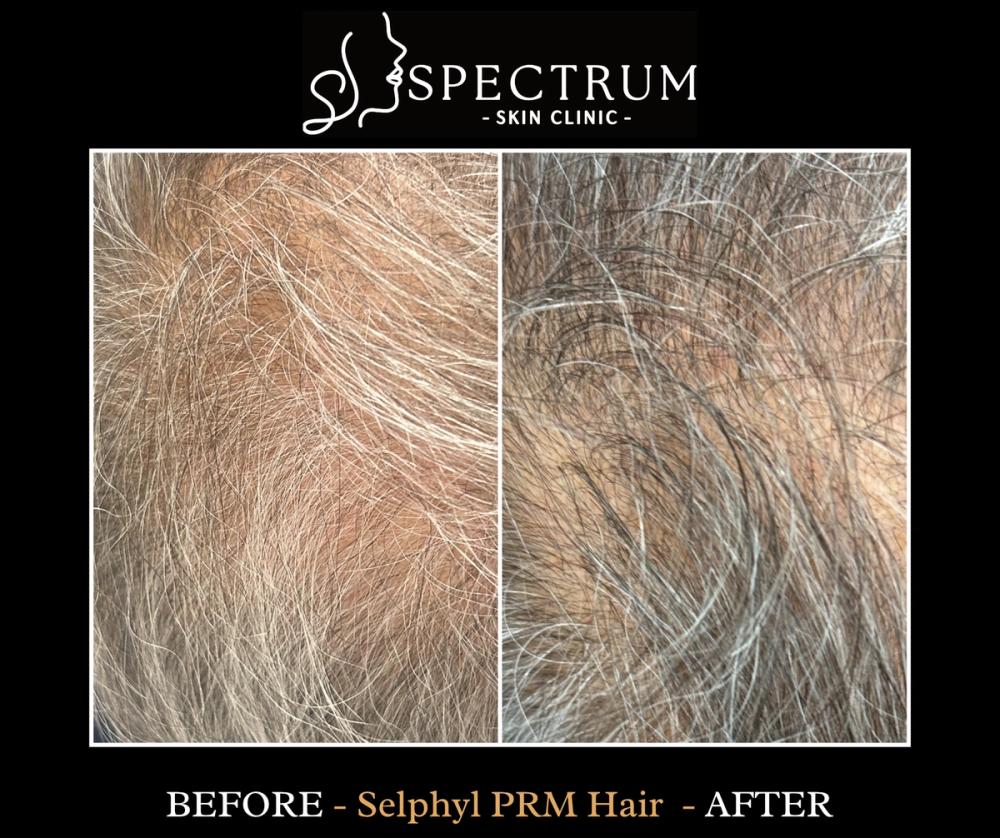 Selphyl PRFM: The Most Advanced Form of PRP for Hair Restoration