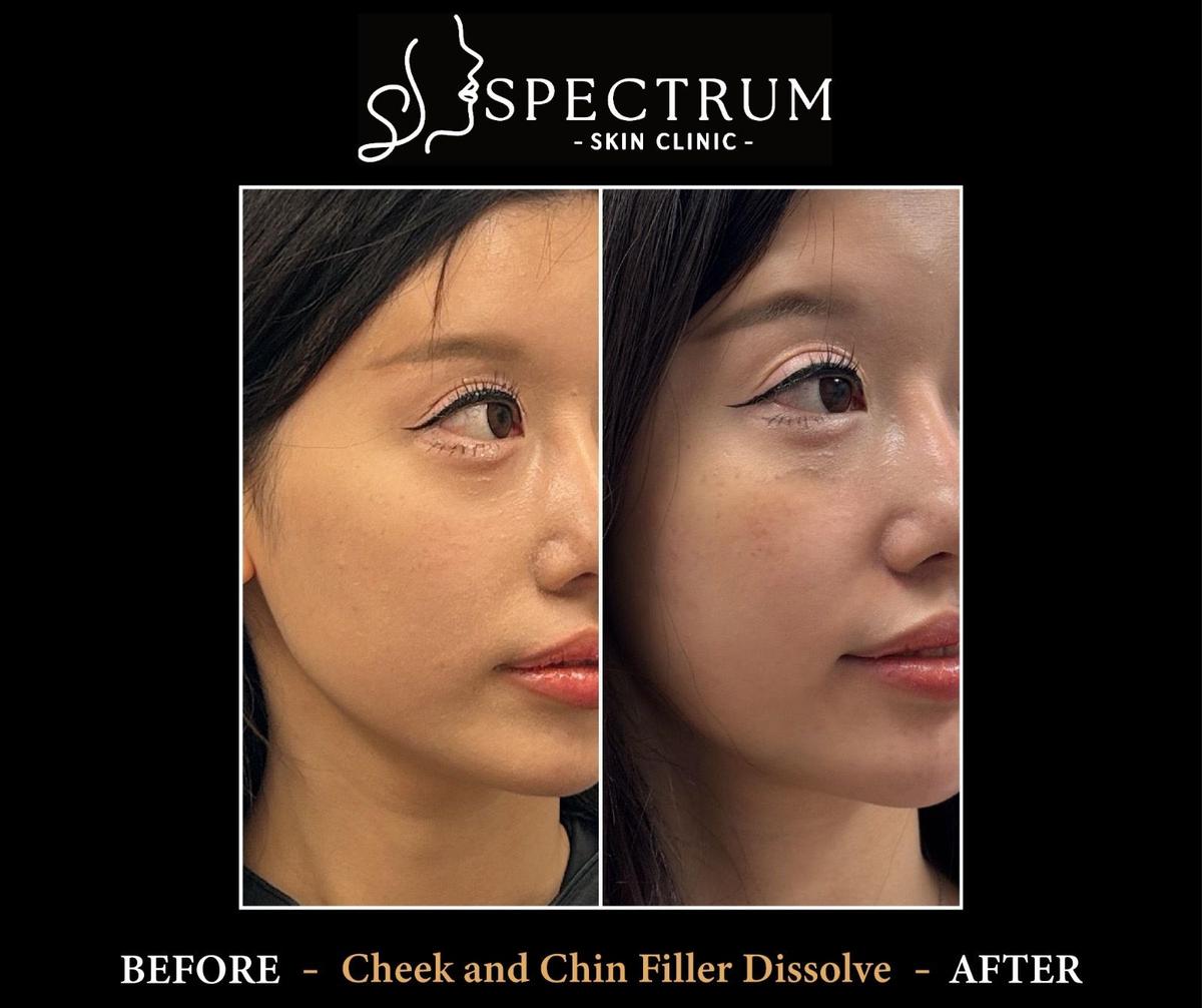 How Long Does Filler Take to Dissolve Naturally?