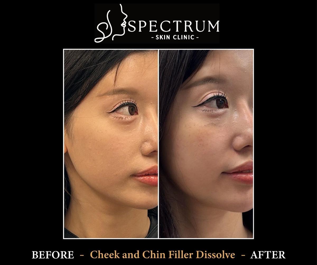 How Long Does Filler Take to Dissolve Naturally?