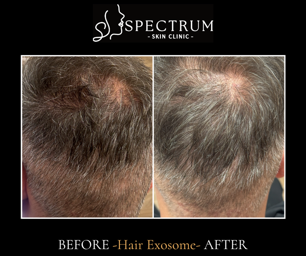 Non-Surgical Hair Restoration in Irvine — Exosome Therapy & Selphyl PRFM
