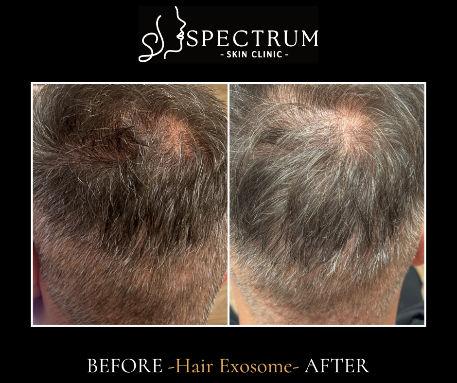 Non-Surgical Hair Restoration in Irvine — Exosome Therapy & Selphyl PRFM