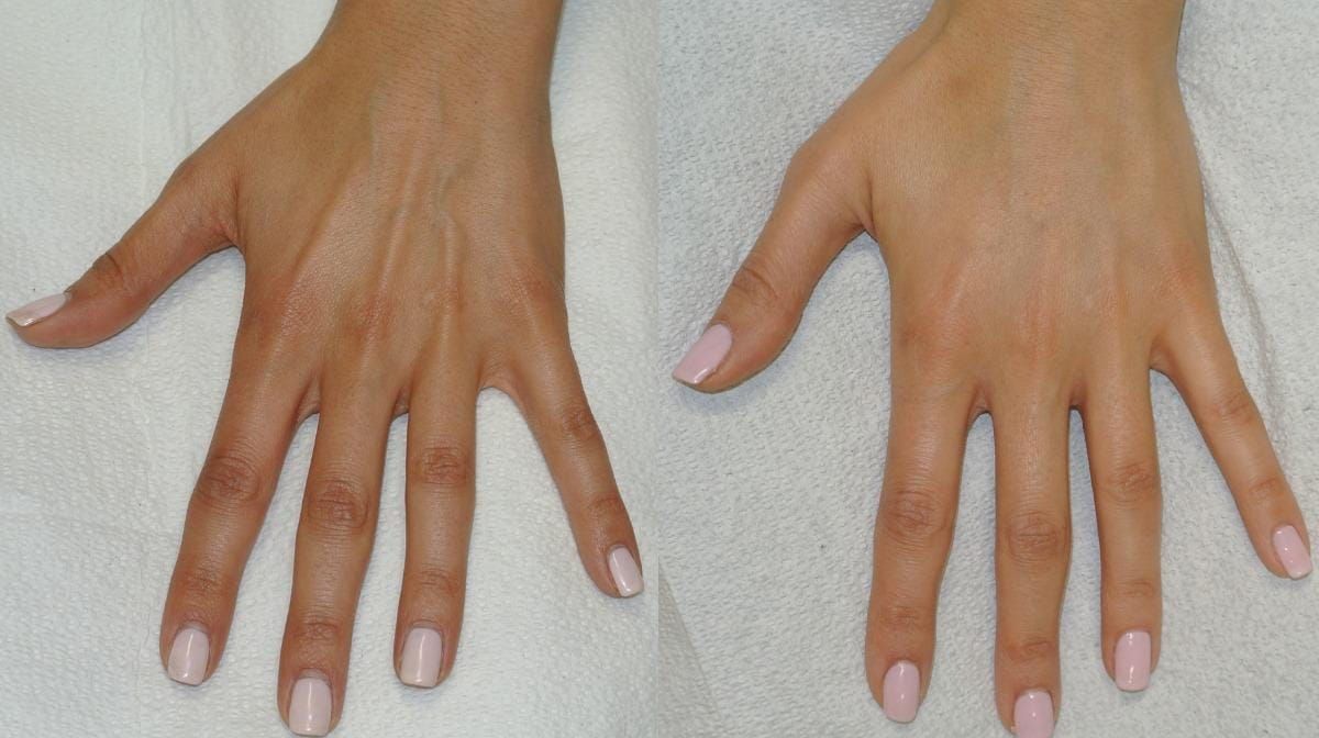 Hand Rejuvenation