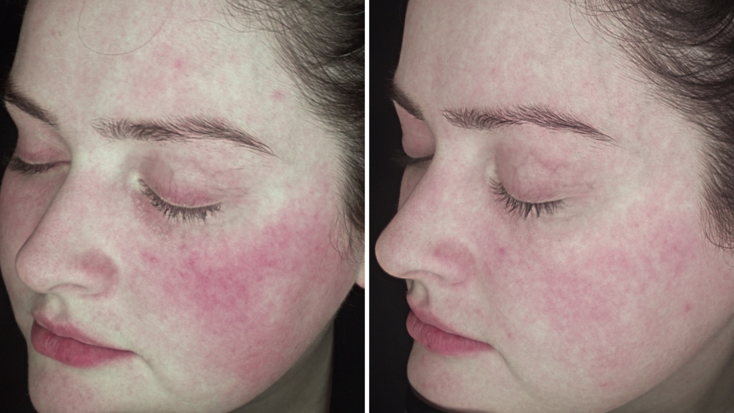 Rosacea