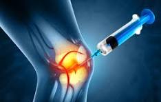 PRP Joint Injections