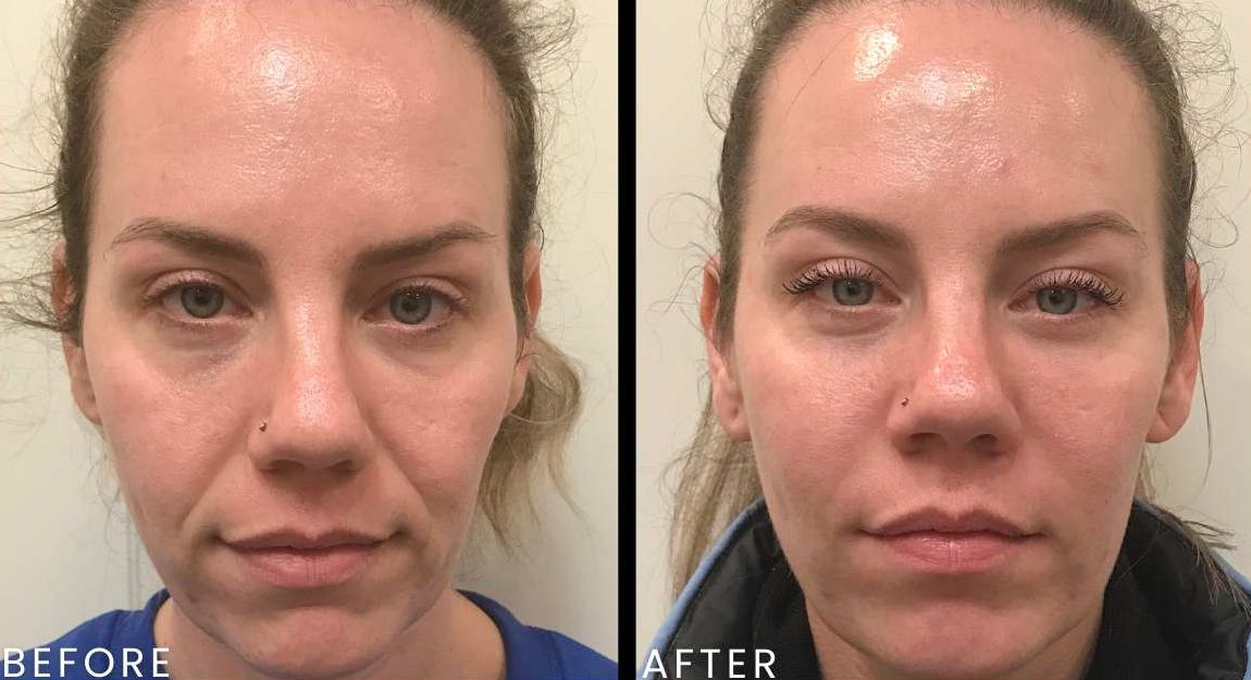 Volume Loss in the Face