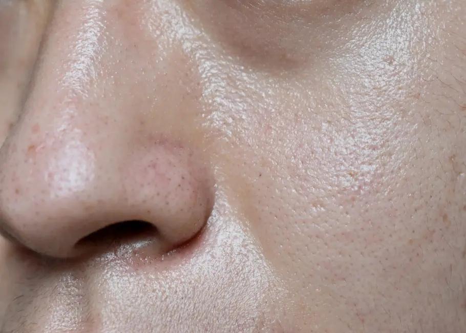  Oily and Congested Skin