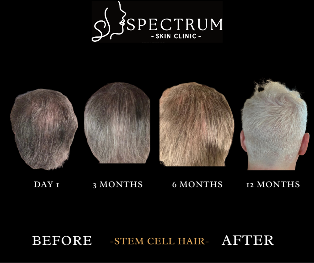 From Consultation to Recovery: Your Hair Restoration Appointment