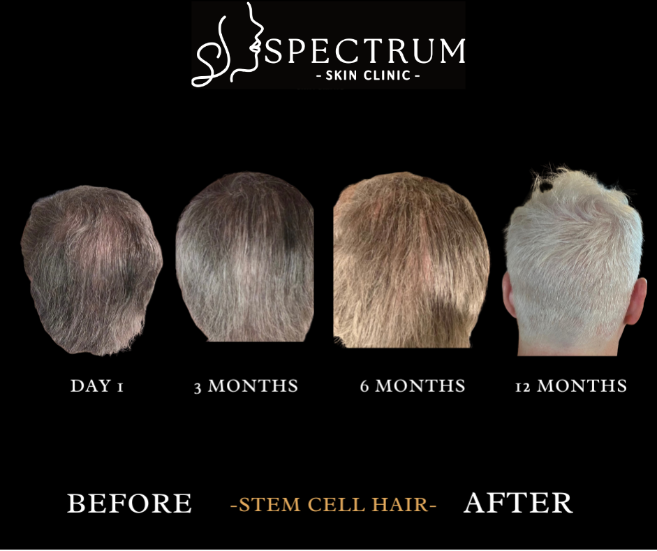 From Consultation to Recovery: Your Hair Restoration Appointment