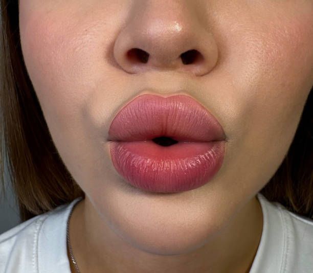 Lip Volume Loss