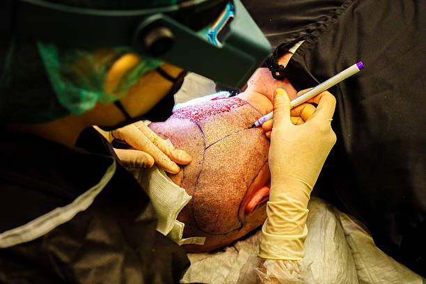 Take the First Step Towards Hair Restoration