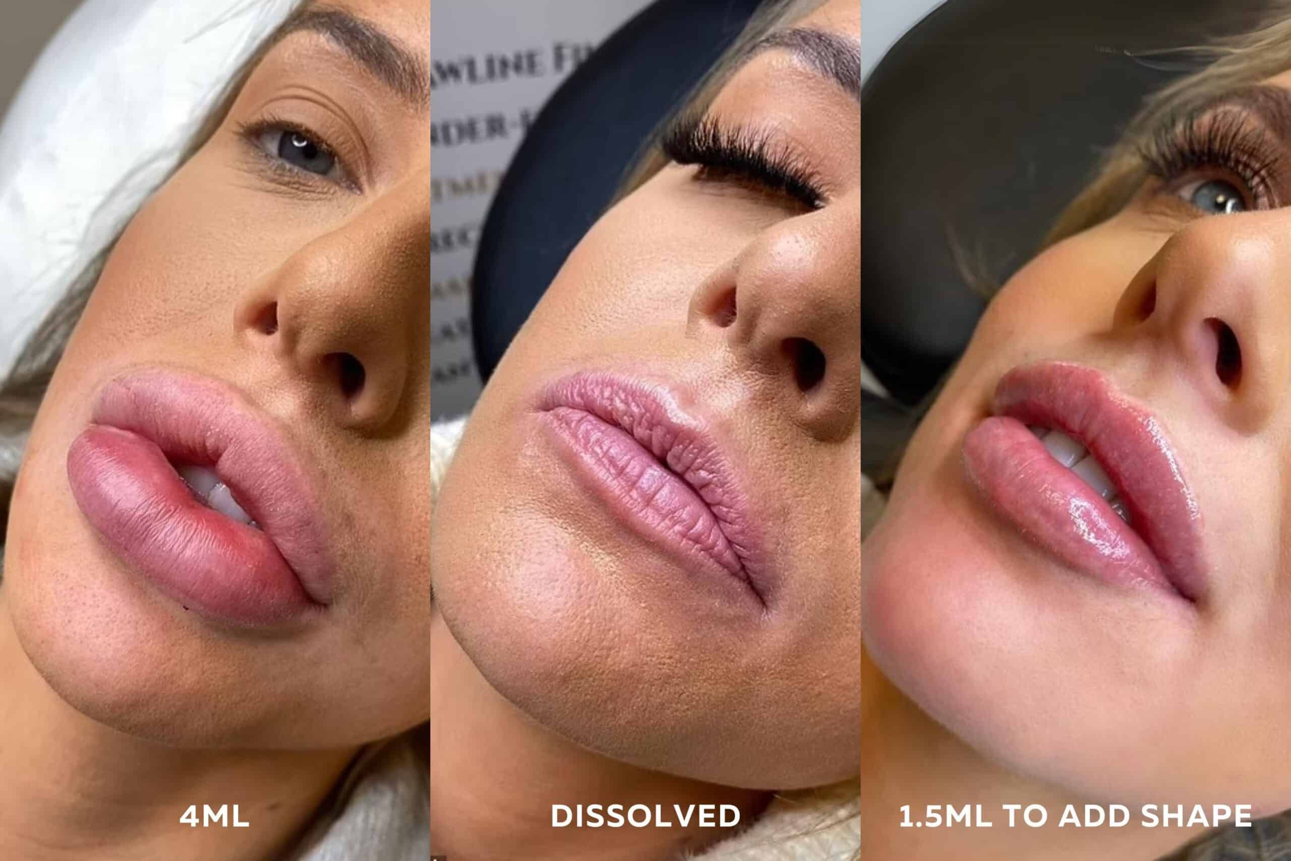Filler Dissolve for Lumps and Bumps