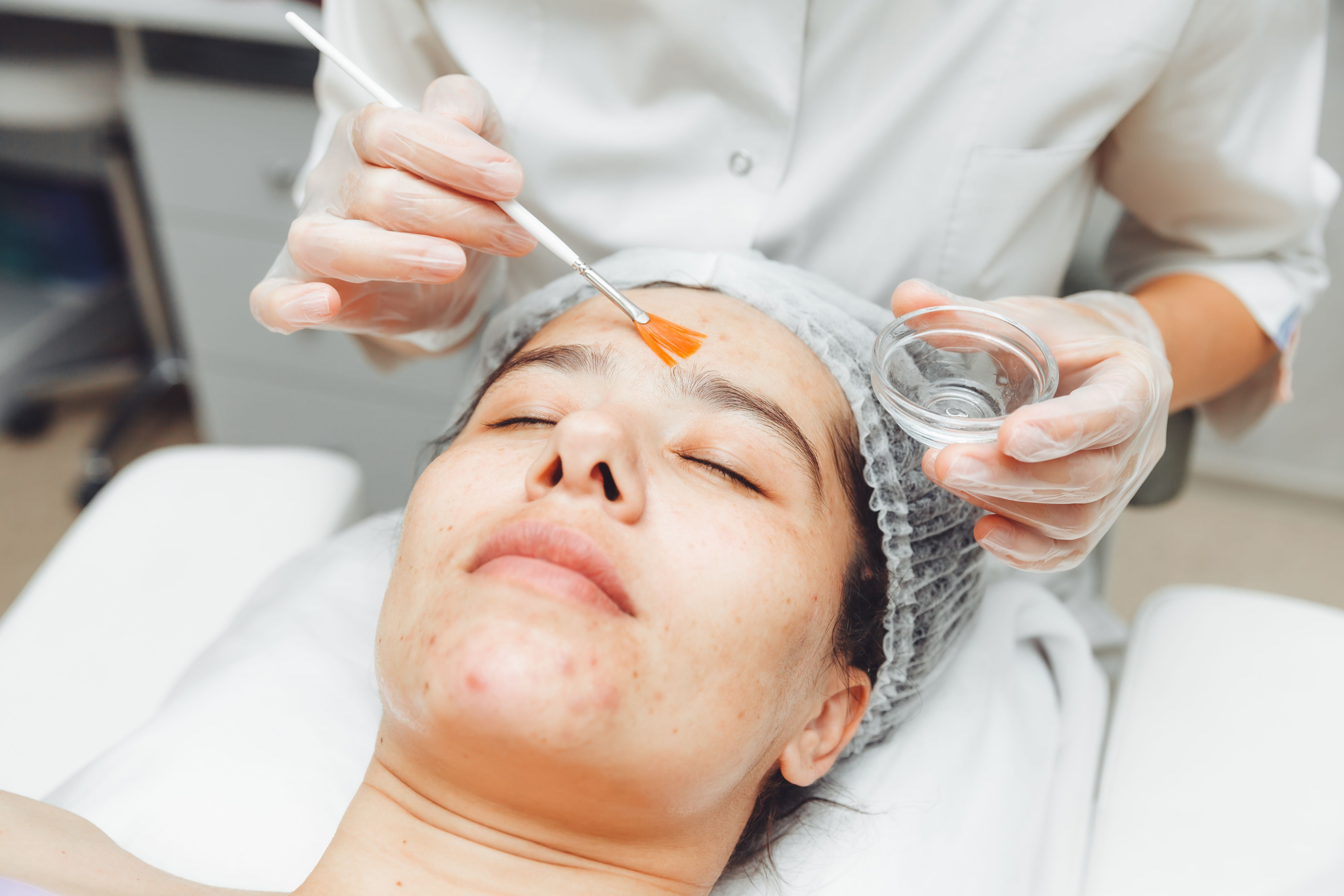 Acne & Acne Scar Treatment