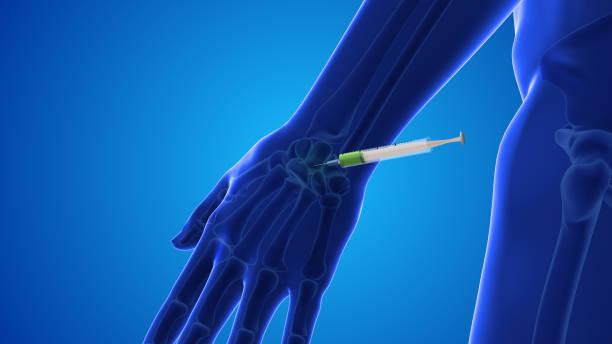 Why Choose The Pur Health for PRP Joint Therapy?
