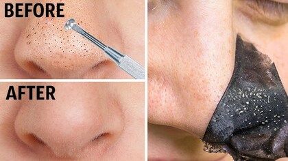 Charcoal Peel for Blackheads