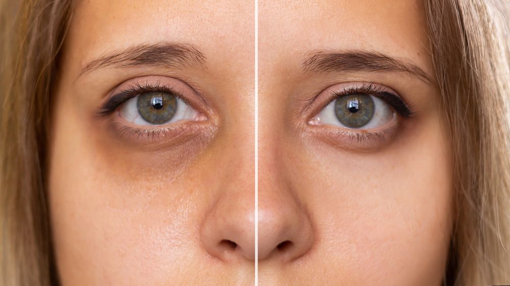 Dark Circles Under Eyes