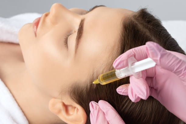 Benefits of PRP for Hair Loss