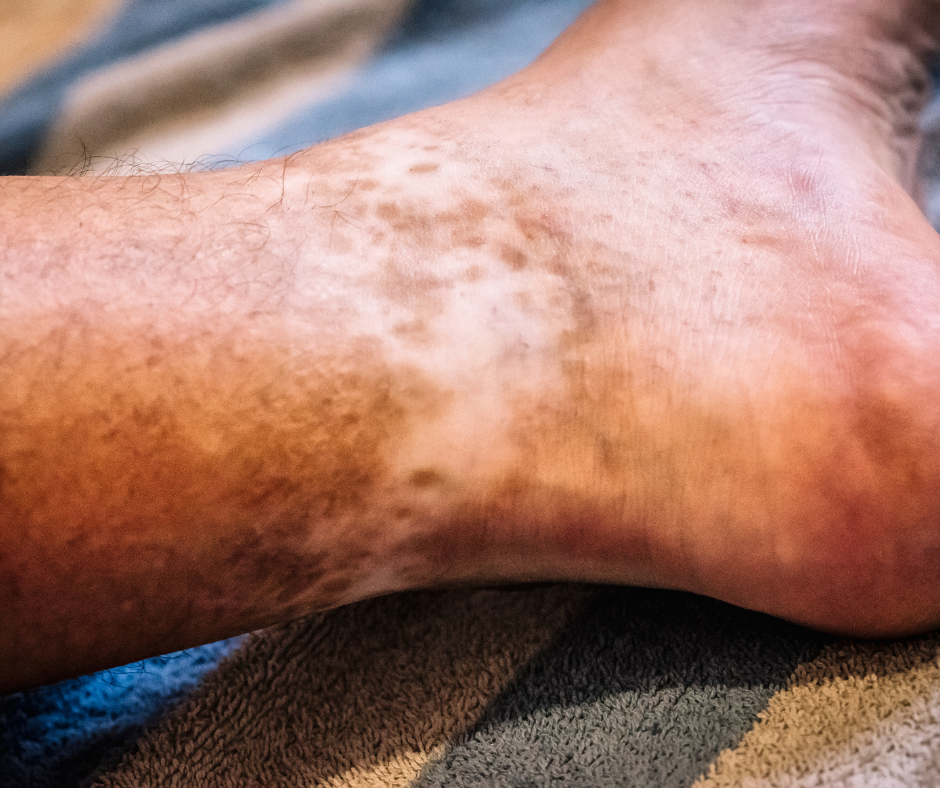 Melasma