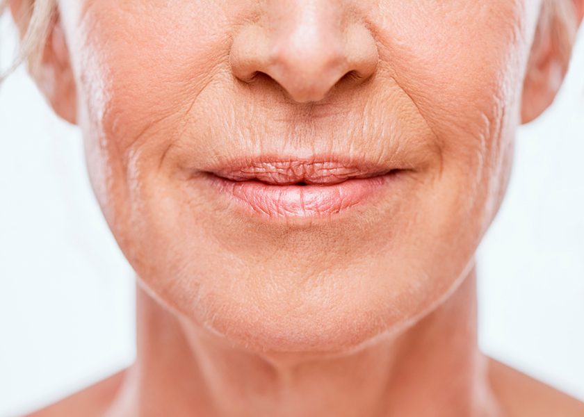 Vertical Lip Lines (Smoker’s Lines)