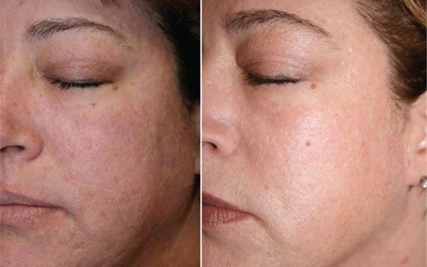 What Is Fractional CO₂ Laser Resurfacing?