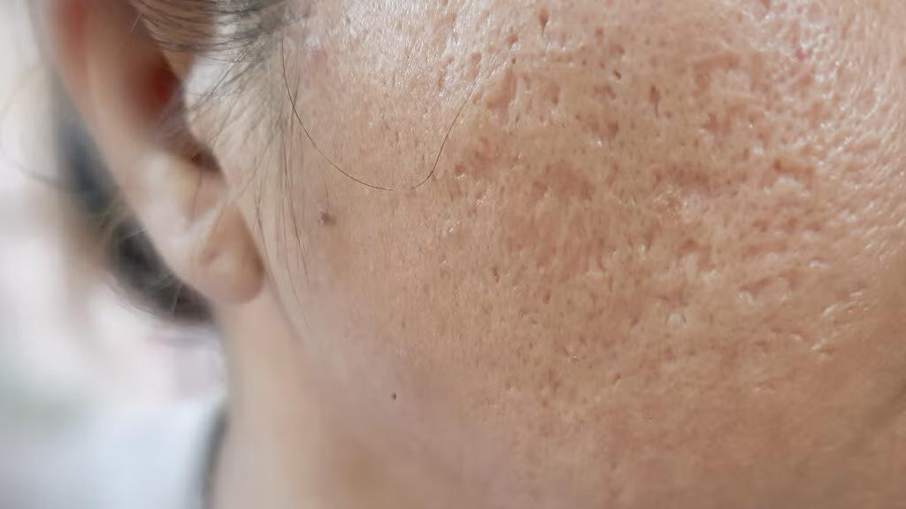 Acne Scars